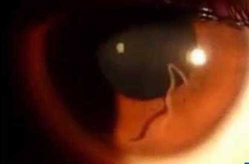 真实存在的16个骇人听闻疾病-罗阿丝虫病