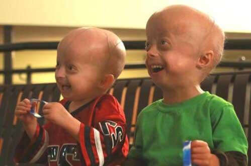 真实存在的16个骇人听闻疾病-儿童早衰症