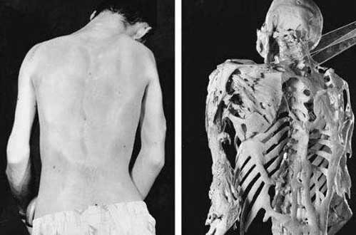 真实存在的16个骇人听闻疾病-进行性肌肉骨化症